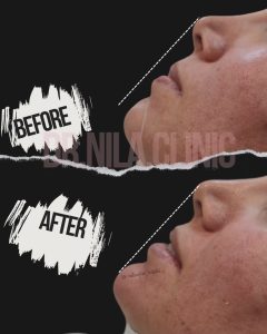 اصلاح فرم چانه با تزریق فیلر تزریق فیلر چانه در جنت آباد